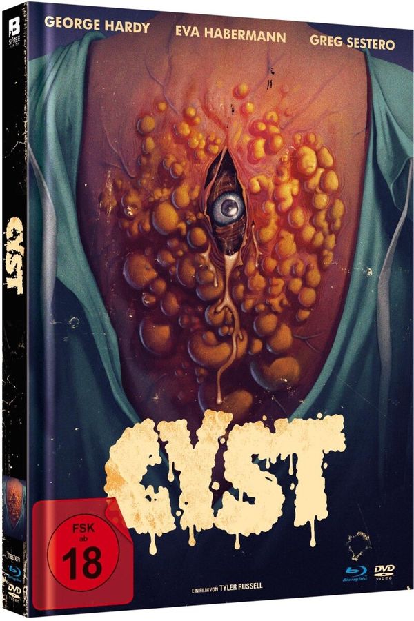 Cyst